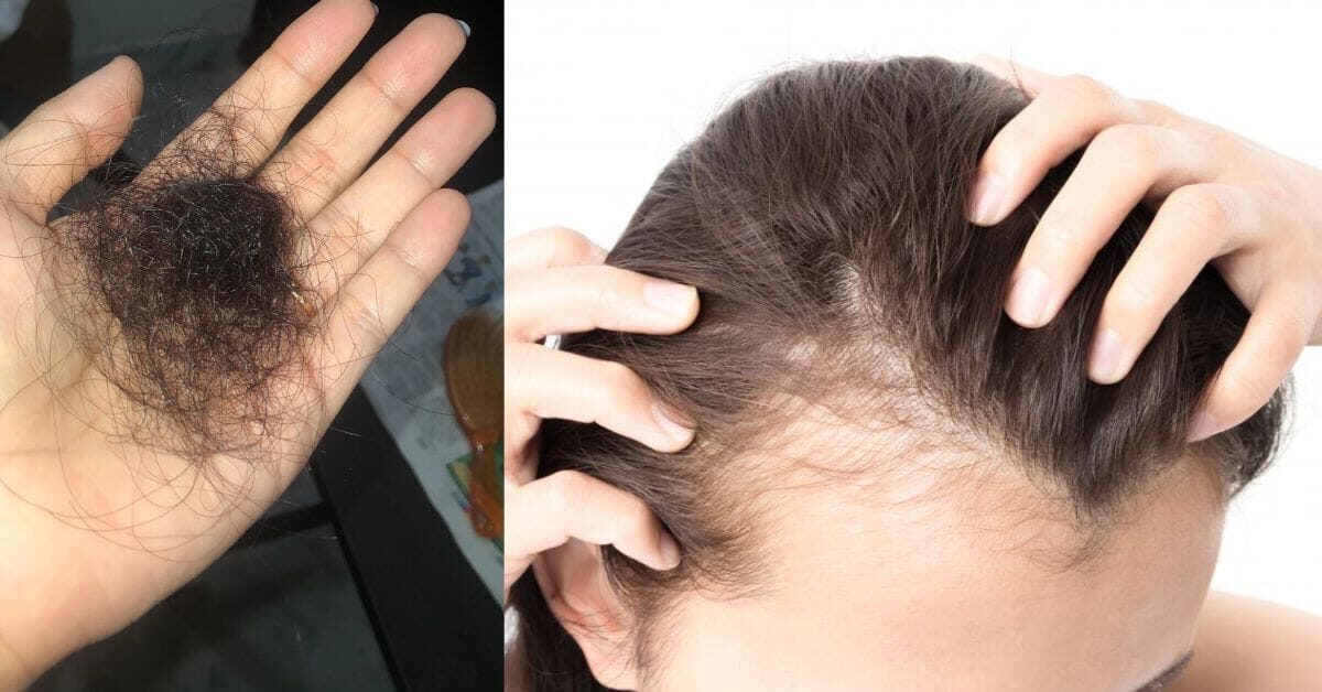 hair fall